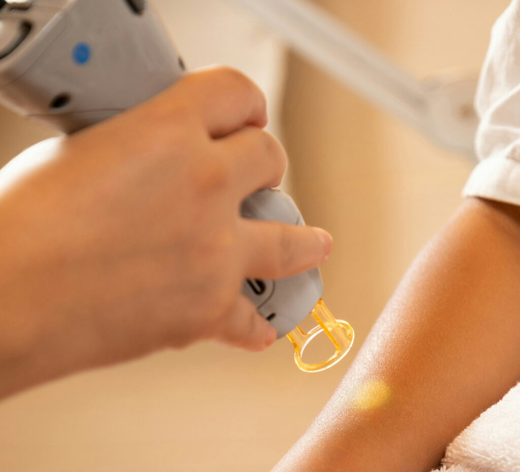 A laser provides hair reduction, not permanent hair removal in Burlington