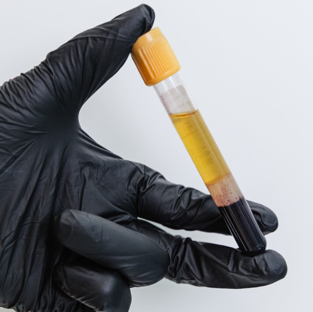 A gloved provider holds a vial of PRP for injections of platelet enriched plasma in Chapel Hill.