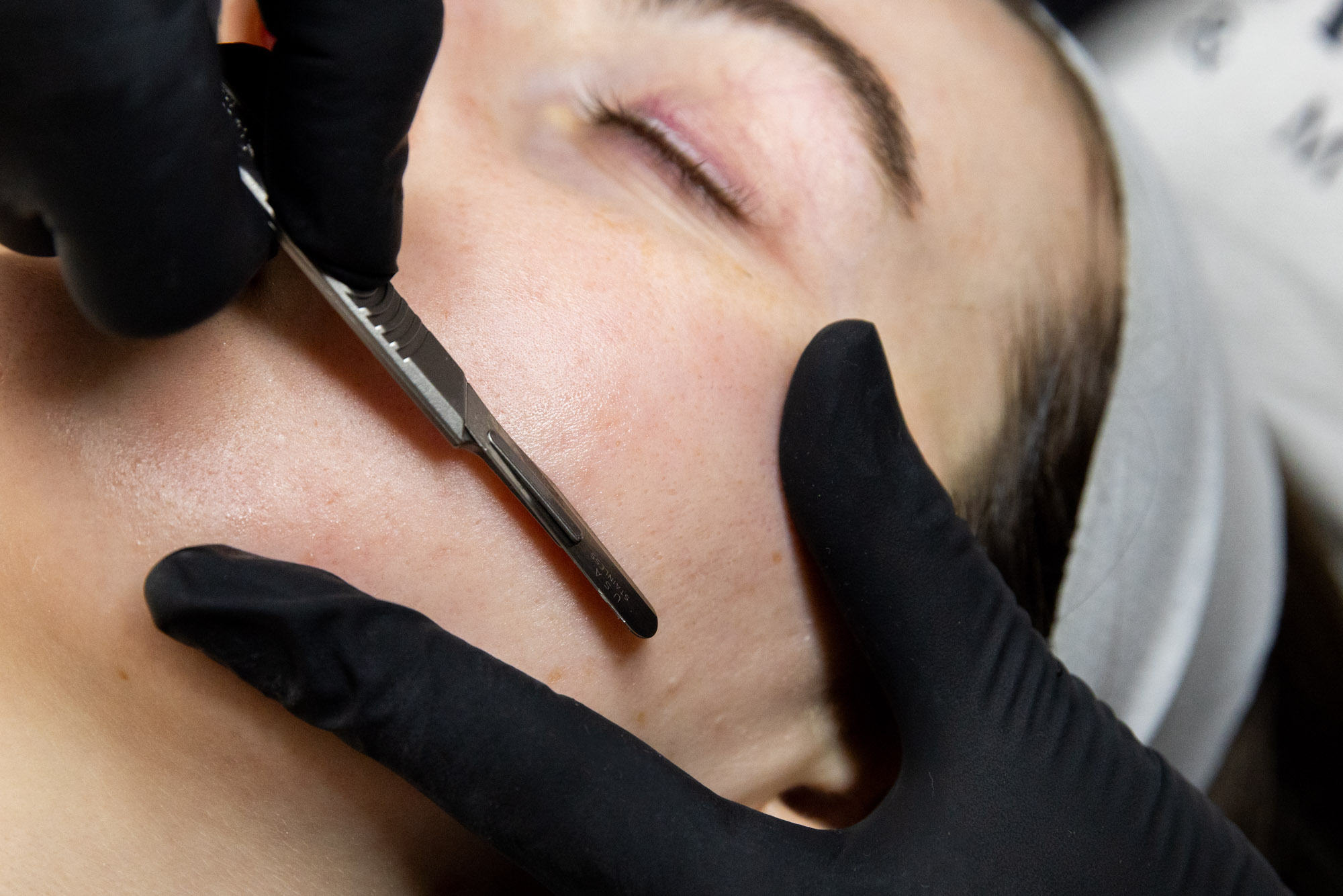 Dermaplaning