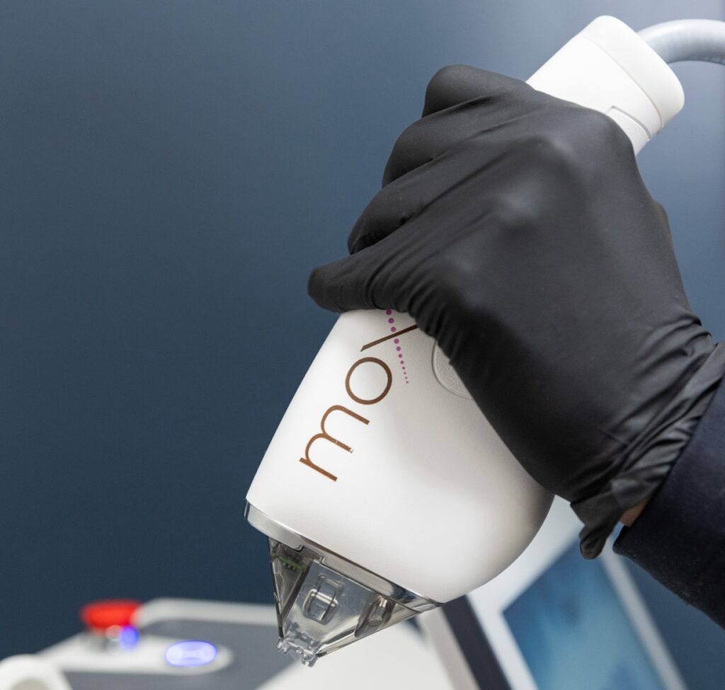 A close-up on the Moxi for the best treatment for acne scars in Chapel Hill